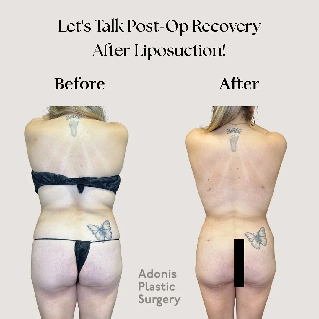 ✨ What to Expect After Liposuction ✨

Your transformation doesn&rsquo;t end after surgery! Proper recovery is key to achieving smooth, beautifully defined results. Our expert medical team at Adonis Plastic Surgery is here to guide you through every s