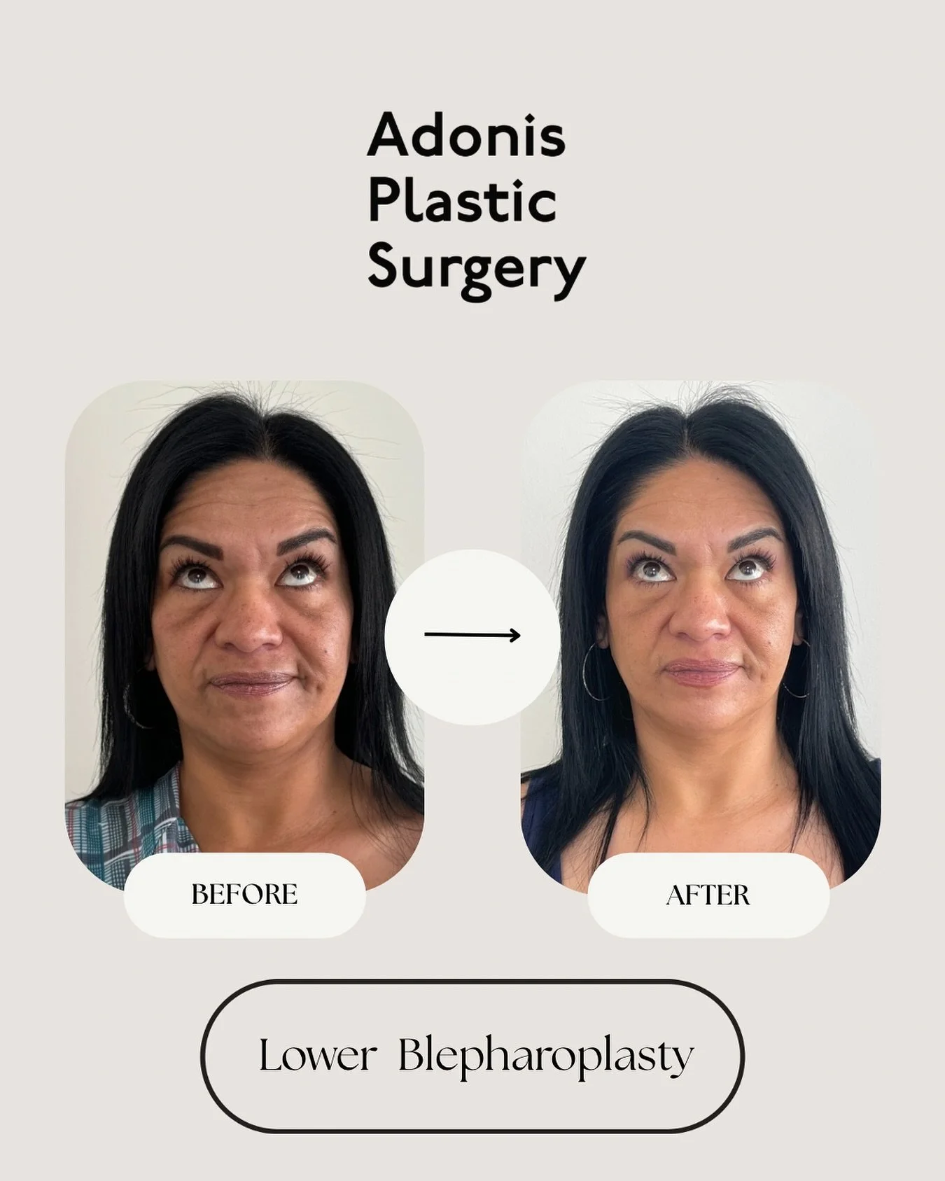 👁 In the before and after shown here, our beautiful patient underwent lower blepharoplasty to reduce puffiness, smooth under-eye bags, and create a refreshed, youthful look.

Why choose lower blepharoplasty?
✔️ Restores a brighter, more awake appear