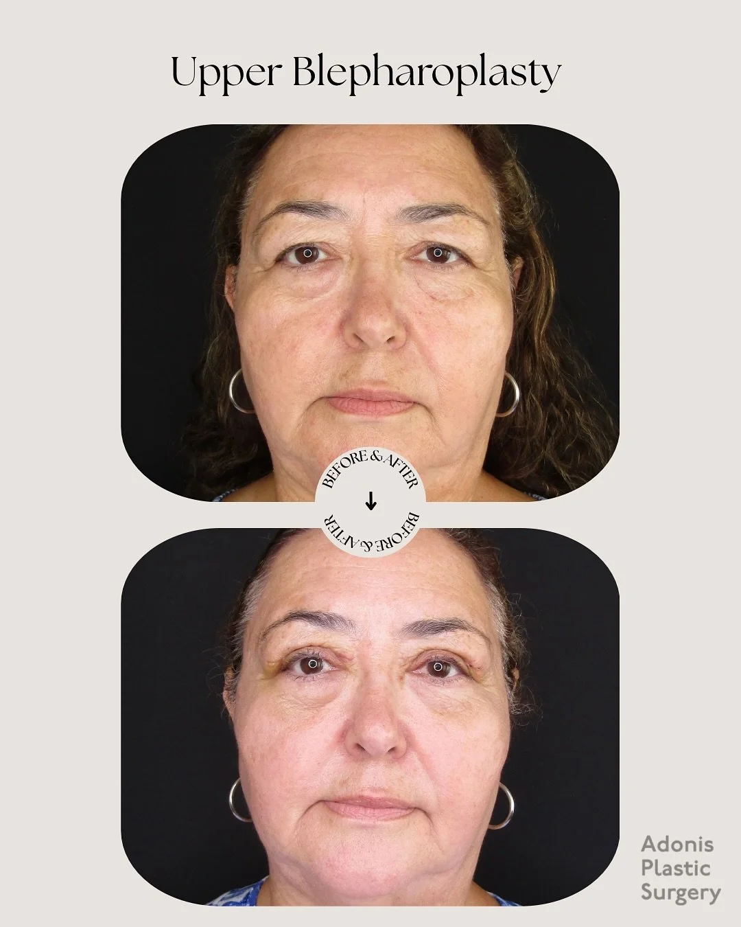 This lovely patient came to us wanting a refreshed, natural look, without changing her unique features.
✨ The result? Brighter, more open eyes that look youthful, natural, and completely her!

So what exactly is an Upper Blepharoplasty? 👇
It&rsquo;s