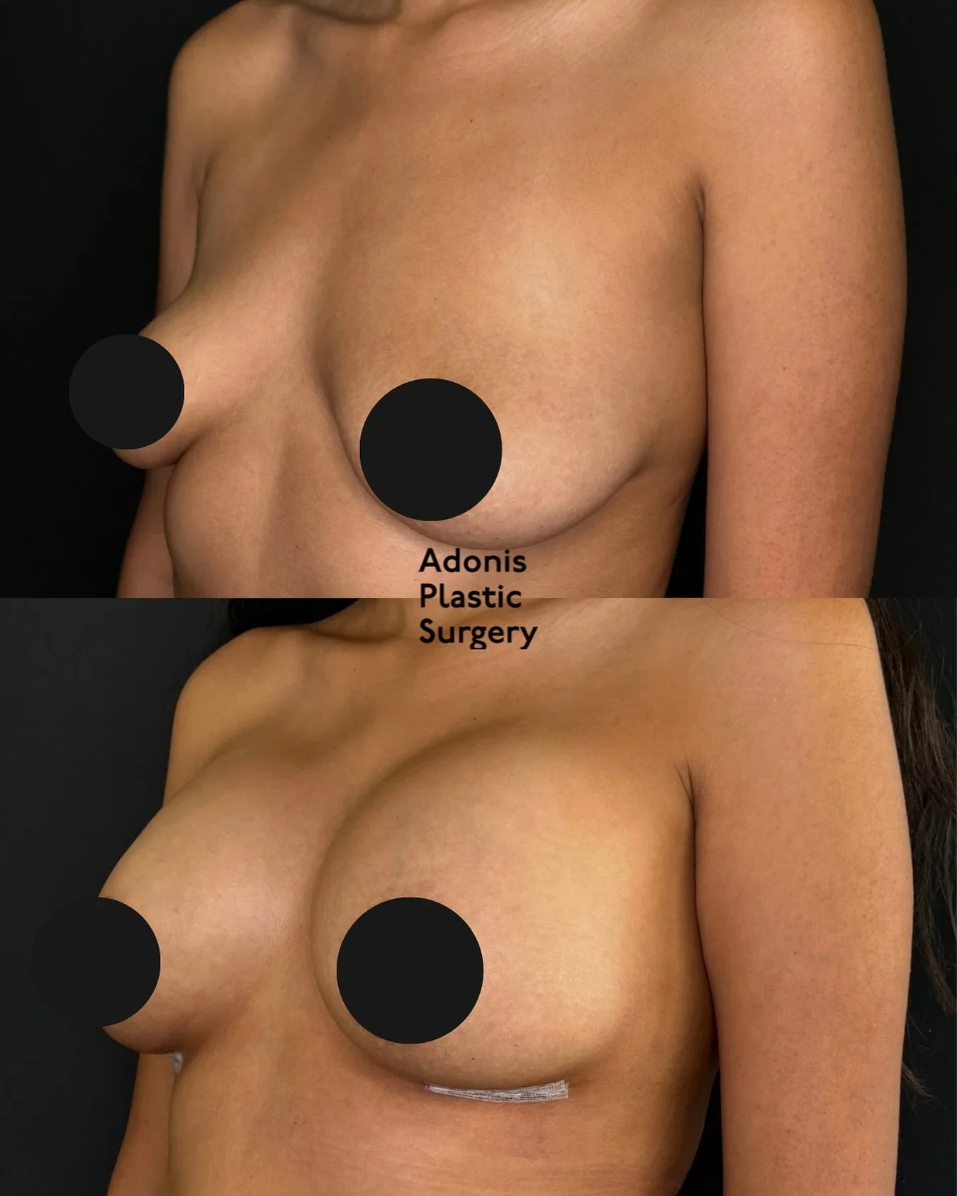 This gorgeous result comes from a breast augmentation performed by Dr. Jacobson using silicone implants. The goal was to enhance volume, improve upper pole fullness, and create a natural, balanced shape that beautifully complements the patient&rsquo;
