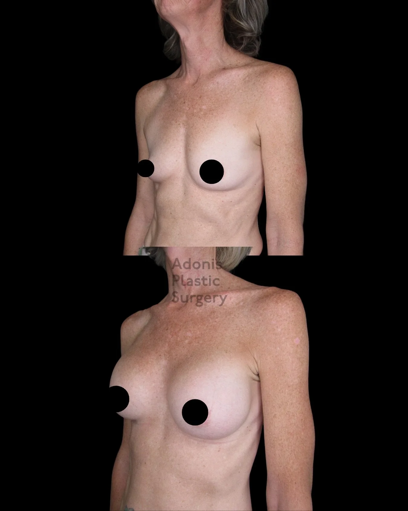 ✨ From subtle to stunning ✨
This beautiful patient went from very small breasts to a fuller, natural-looking medium cup with 300cc Motiva implants by Dr. Kalaria. The result? A balanced, feminine shape that fits her frame perfectly. 💕

Thinking abou