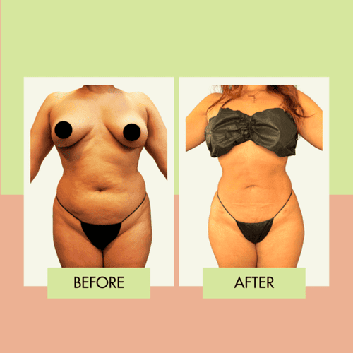 Lipo 360 before and after for a South Bay patient