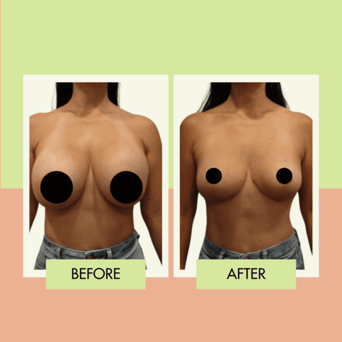 Reduction mammaplasty before and after in Torrance