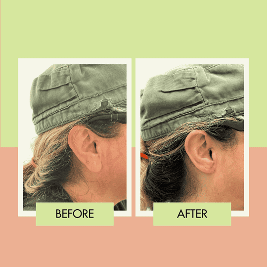 Earlobe reduction before and after at Adonis Plastic Surgery in Torrance