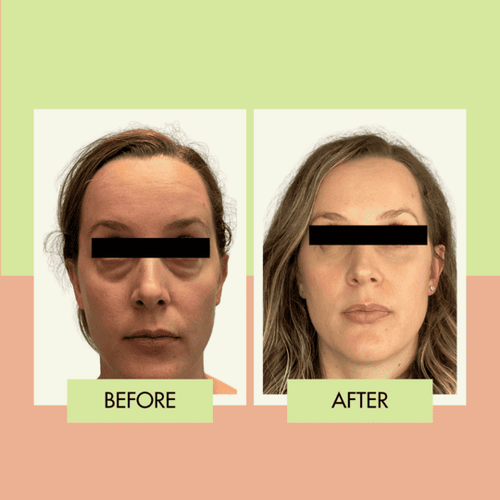 Transconjunctival lower eyelid rejuvenation before and after for a Palos Verdes patient