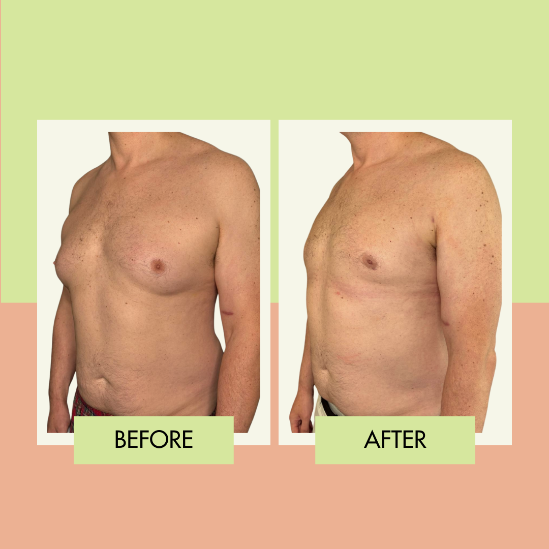 Male breast reduction before and after showing chest contour improvement