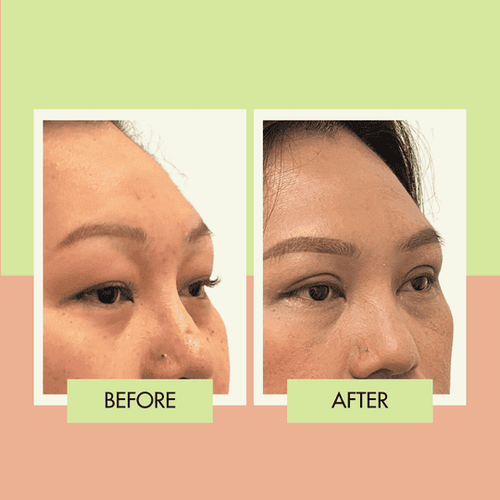 Double eyelid surgery before and after in Torrance