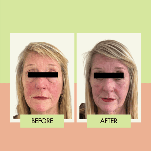 Lower eyelid surgery before and after for a Redondo Beach patient