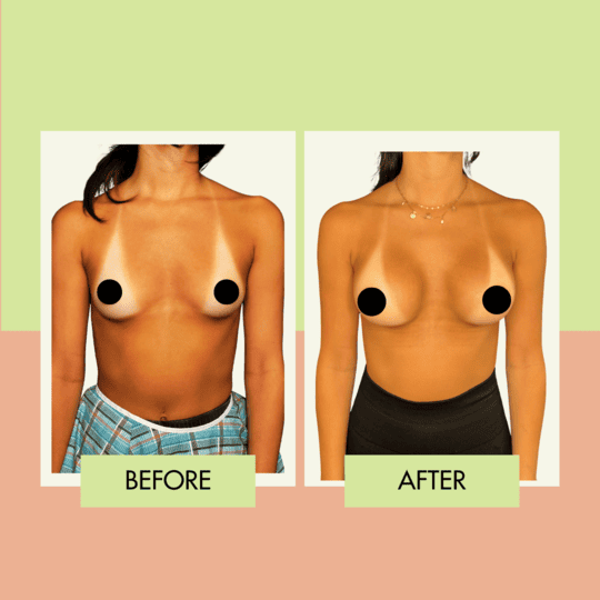 breast+augmentation+implant+before+after+in+torrance+los+angeles