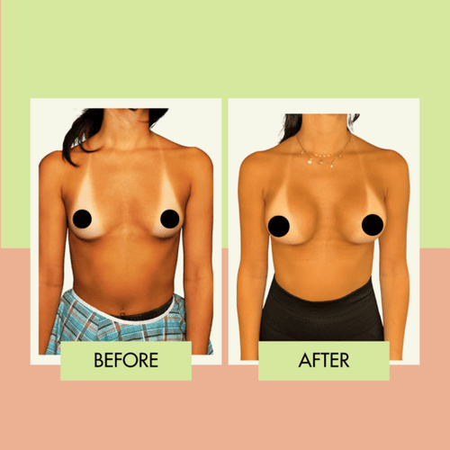Breast augmentation before and after at Adonis Plastic Surgery in Torrance