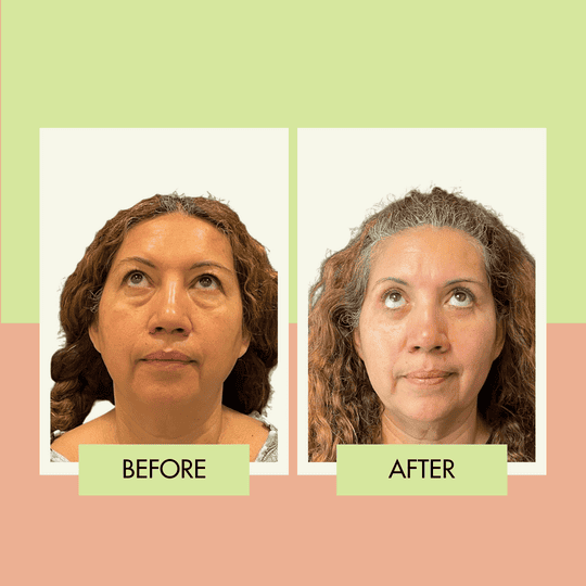 Lower blepharoplasty before and after for a Long Beach patient