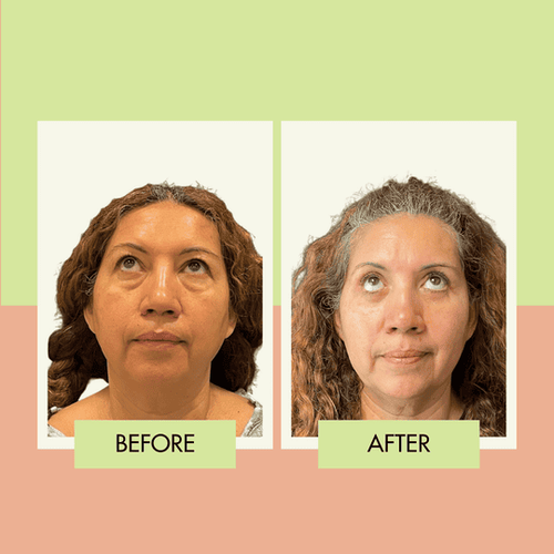 Lower blepharoplasty before and after for a Long Beach patient