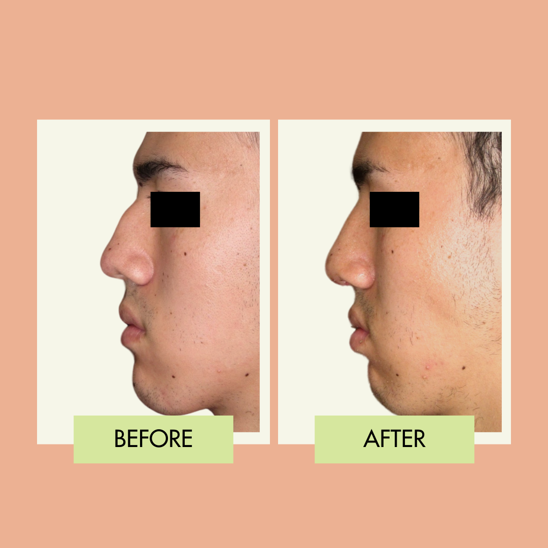 Male rhinoplasty profile before and after near Redondo Beach