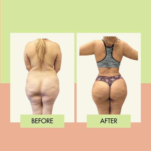 BBL fat transfer and body contouring before and after at Adonis Plastic Surgery