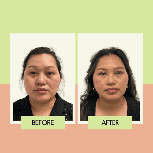 Asian blepharoplasty before and after at Adonis Plastic Surgery in Torrance