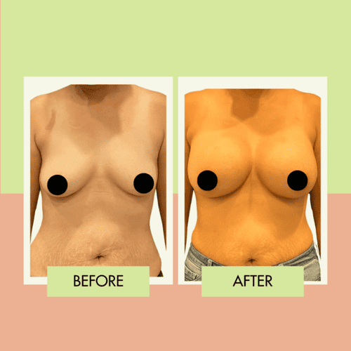 Saline breast implant before and after in Torrance Los Angeles