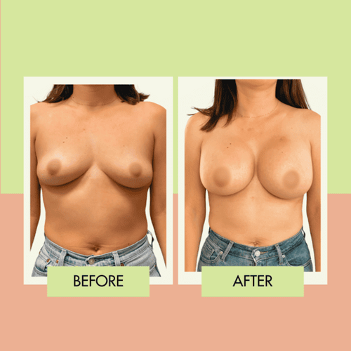 Breast implant augmentation before and after in Torrance and the South Bay