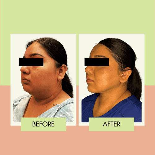 Double chin reduction and jawline contouring before and after in Torrance