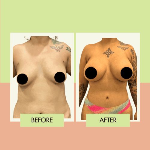 Silicone breast implant before and after in Torrance Los Angeles