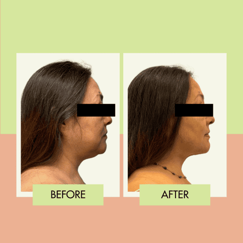 Submental liposuction before and after for a South Bay patient