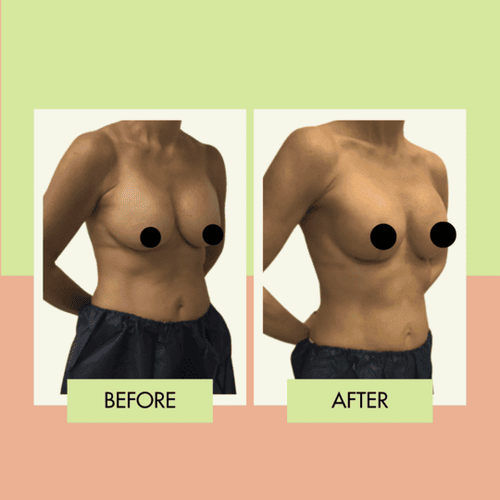 Mastopexy before and after showing higher nipple position in Torrance California