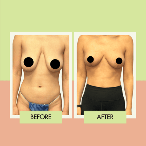 Breast lift before and after at Adonis Plastic Surgery in Torrance