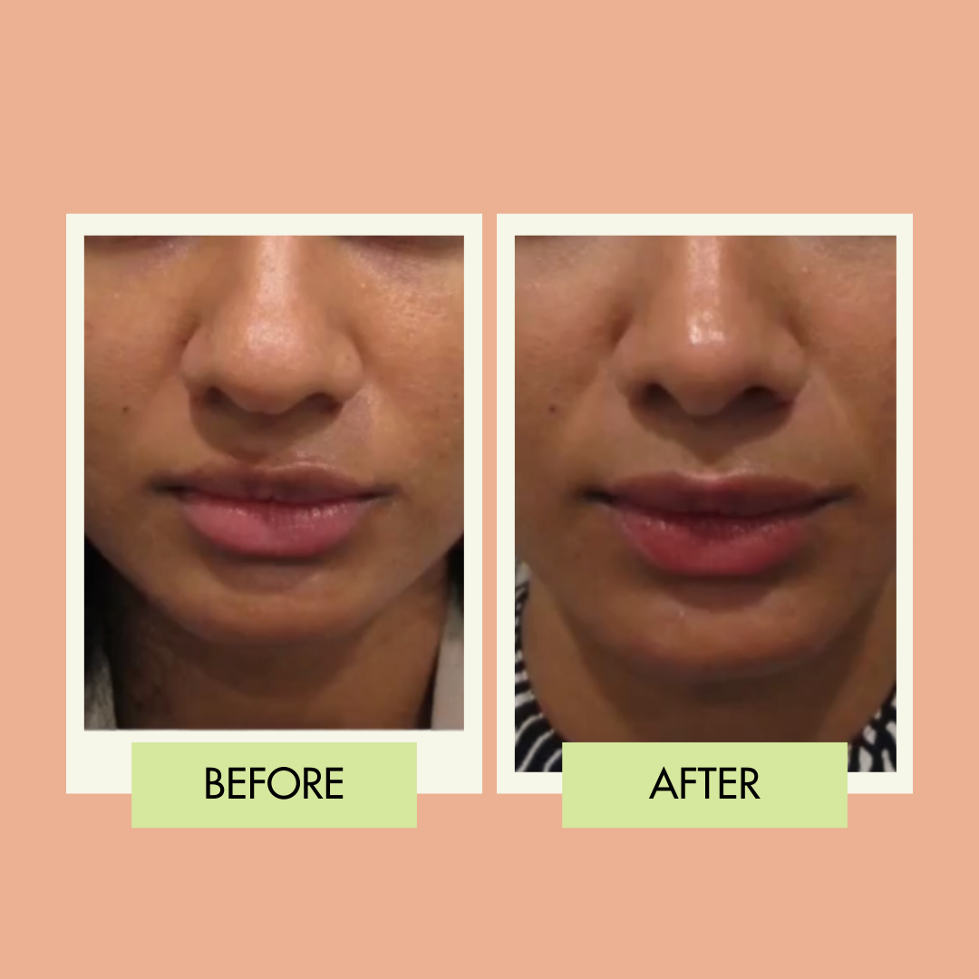 Rhinoplasty frontal before and after for a Redondo Beach patient
