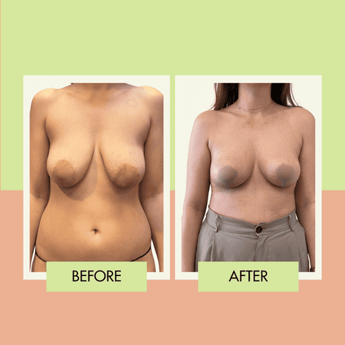 Breast reduction before and after at Adonis Plastic Surgery in Torrance
