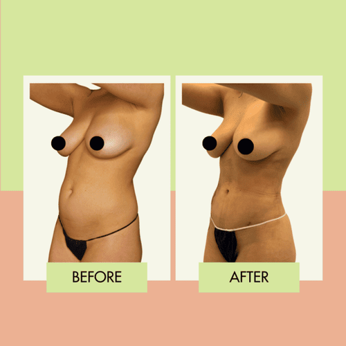 360 liposuction before and after in Torrance and Palos Verdes