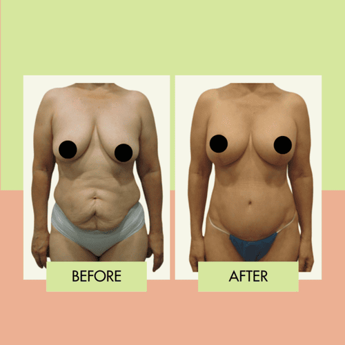 Breast lift before and after in Redondo Beach and Torrance