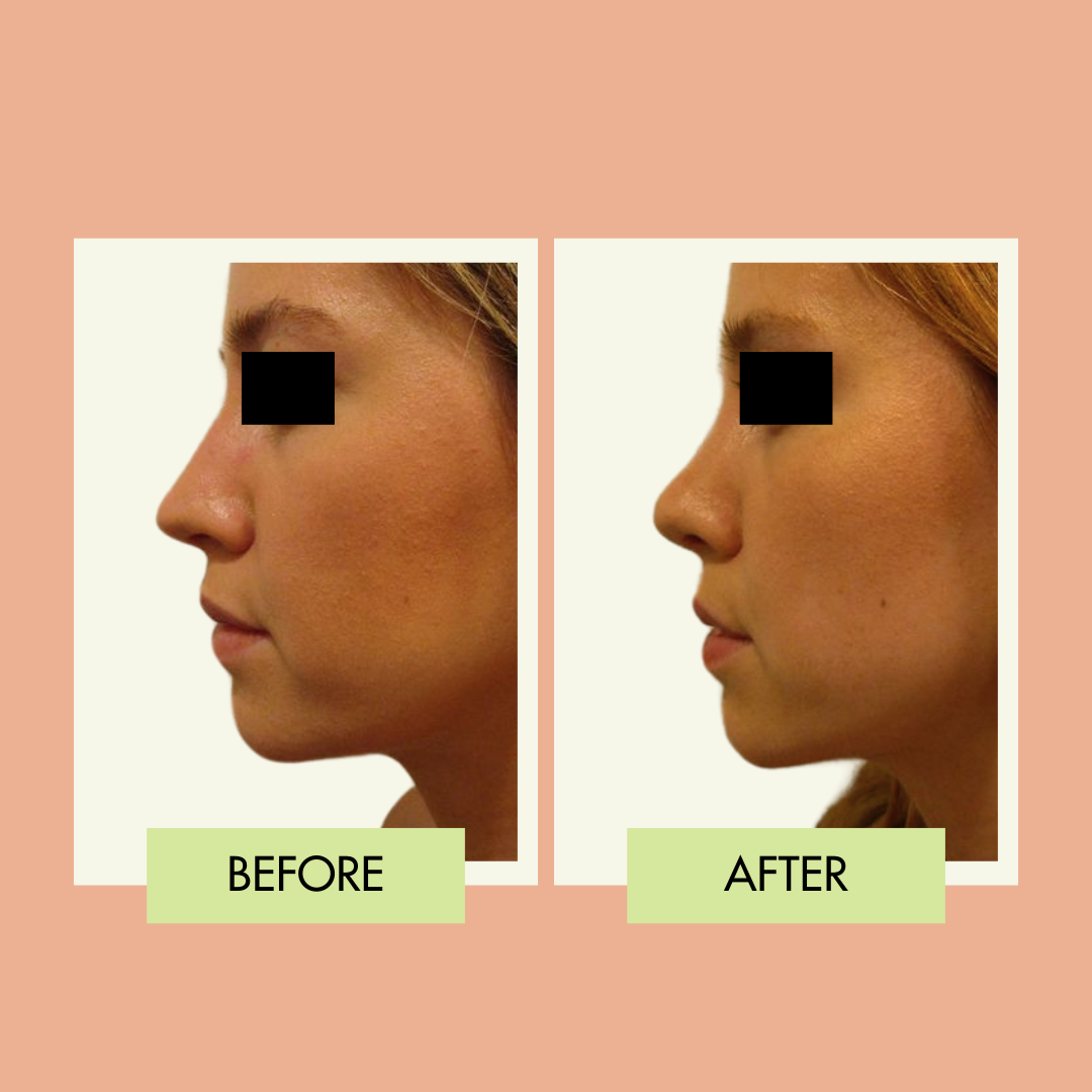 Natural rhinoplasty profile before and after in Torrance