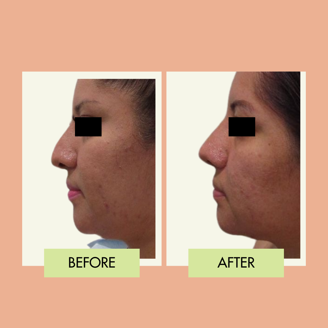 Nose job profile before and after in South Bay Los Angeles