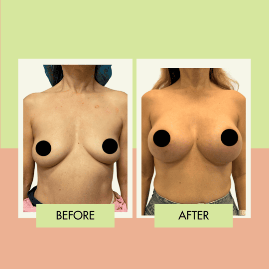 Breast augmentation planning and implant options at Adonis Plastic Surgery