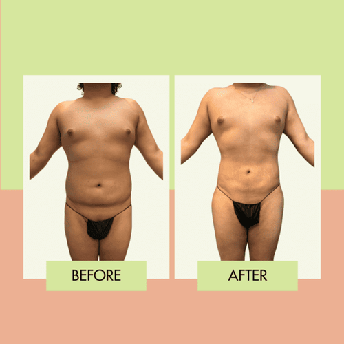 Lipo 360 before and after in Torrance