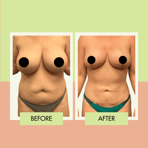 Breast reduction before and after in Torrance and Los Angeles