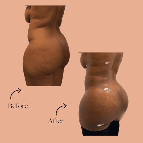Brazilian Butt Lift and liposuction before and after in Torrance