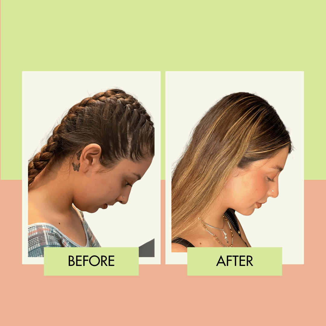 Chin Liposuction in Los Angeles and Torrance — adonis.surgery