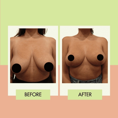Breast reduction before and after for a Palos Verdes patient