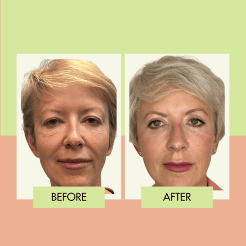 Upper eyelid surgery before and after in Torrance