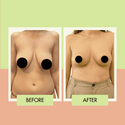 Breast lift without implants before and after for a Redondo Beach patient