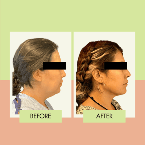 Chin liposuction before and after in Torrance and Redondo Beach
