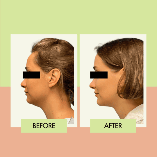 Chin liposuction before and after at Adonis Plastic Surgery in Torrance