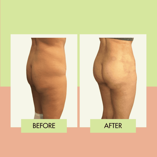 Brazilian Butt Lift before and after in Torrance
