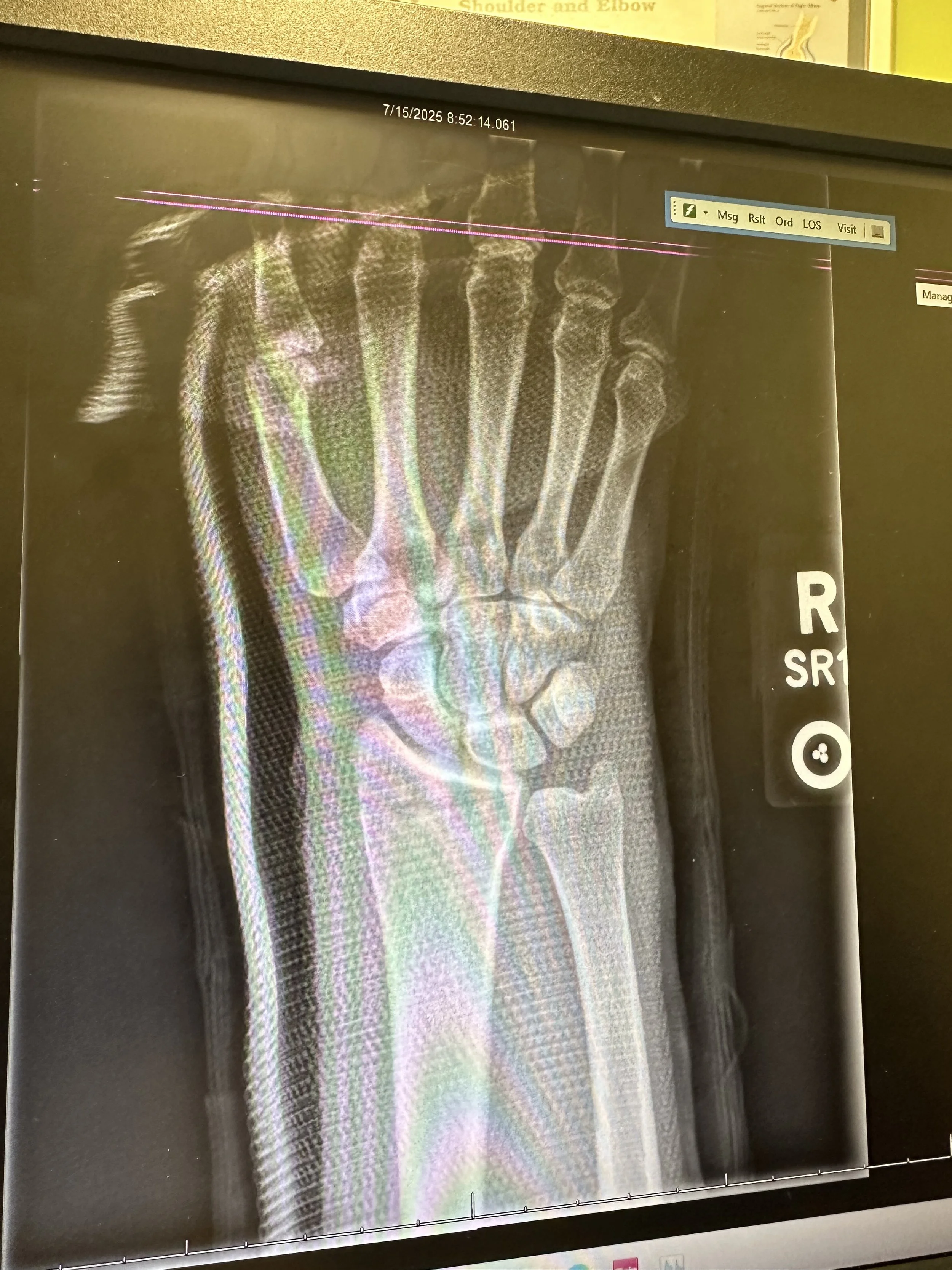 Medical X-ray of a right wrist showing bones and joints.