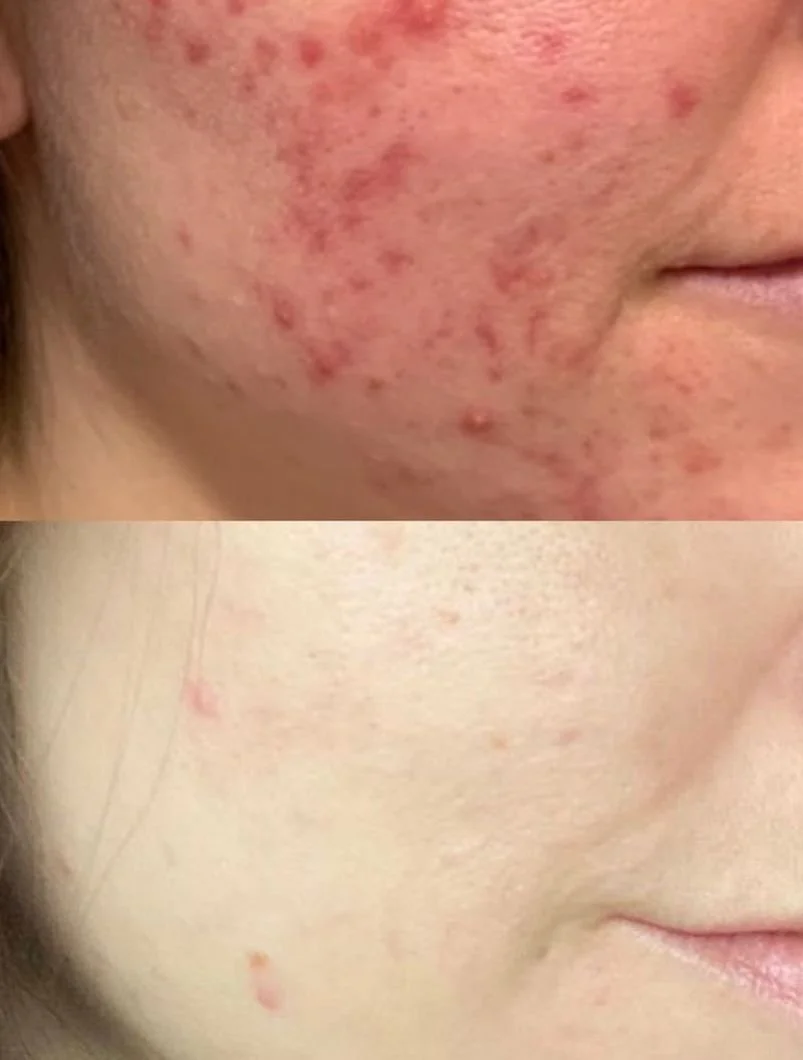 Acne3Treatment copy 4.jpg