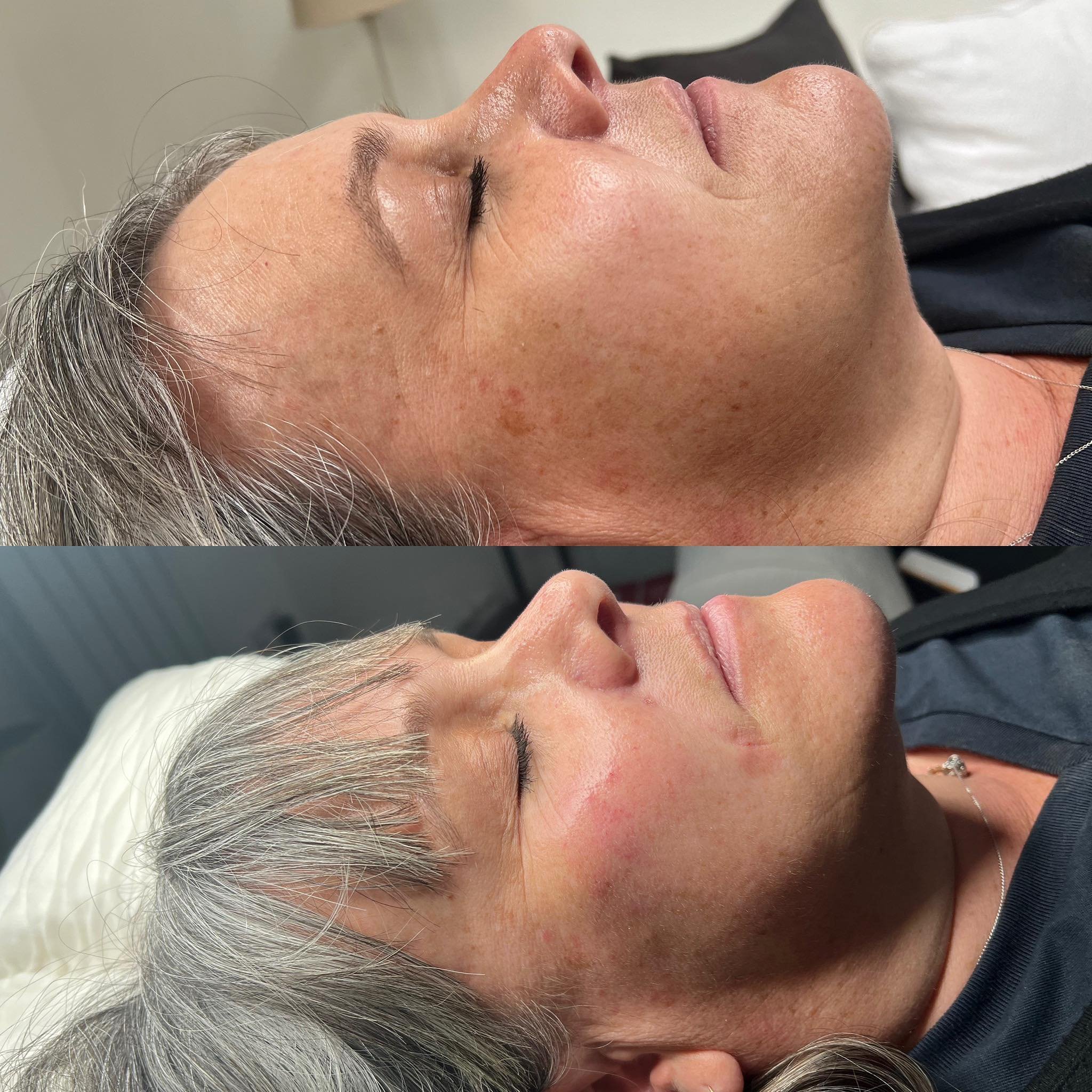 A small amount of dermal filler was used here to add volume back to the cheeks and nasofolds, a natural and rehydrated result ✨