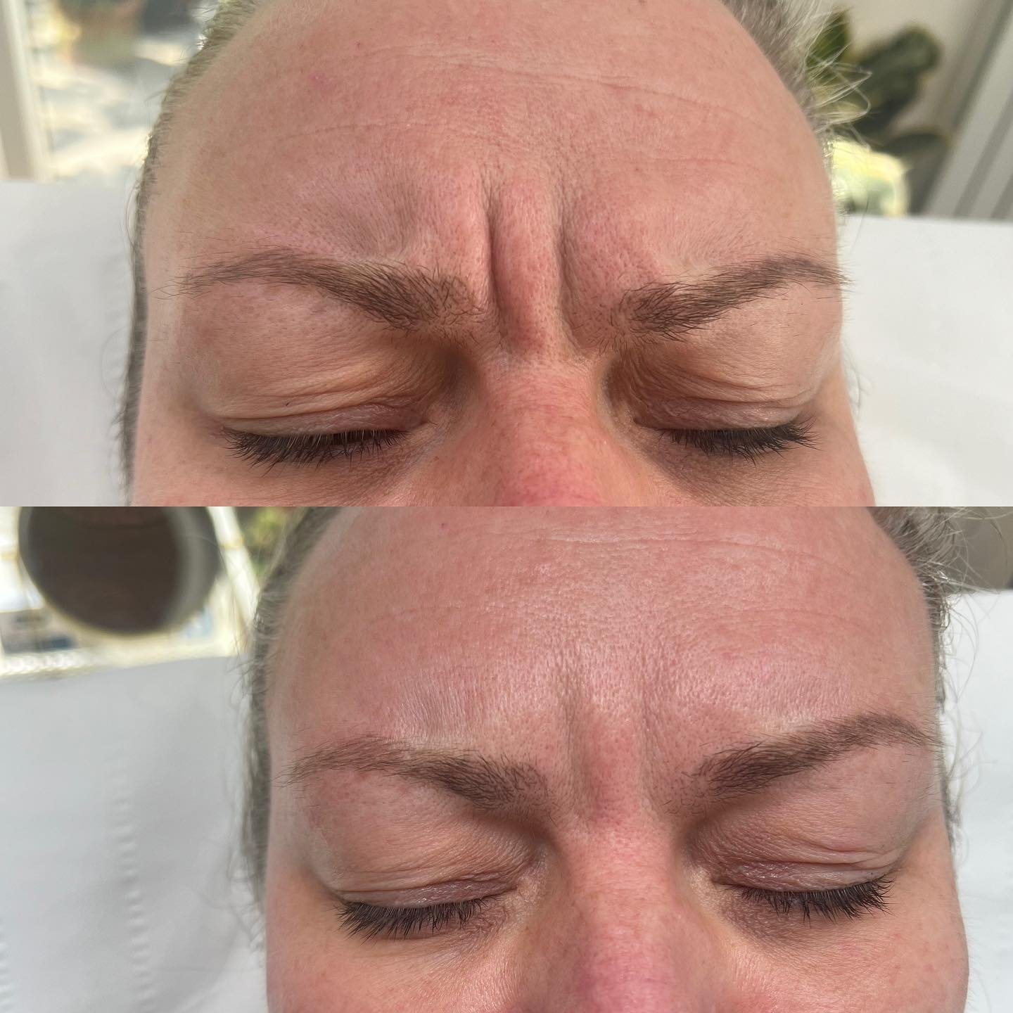 Before - 2 week top up appointment. Softening these frown and forehead lines 👌

Optimal results will be present in approx 2 weeks time 💫