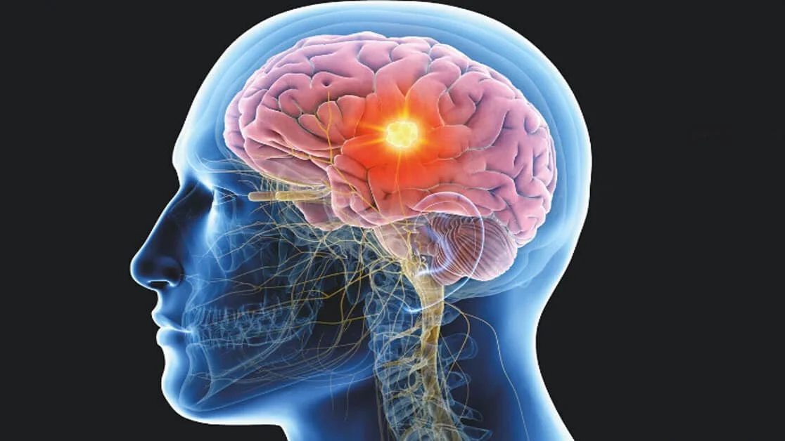 Hyperbaric oxygen therapy (HBOT) treating migraines by increasing oxygen flow to the brain, reducing inflammation, and supporting pain relief and faster recovery.