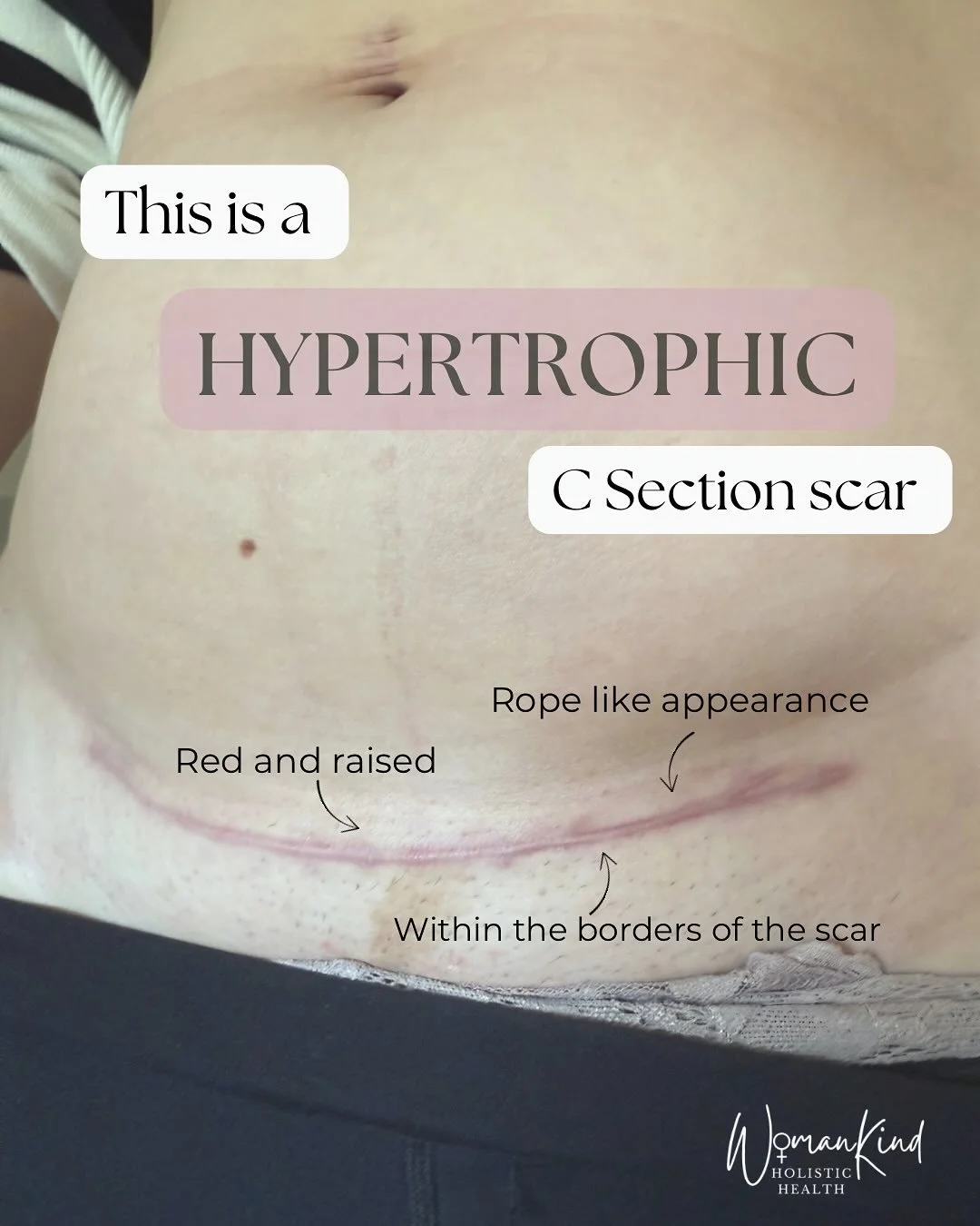 🪬 Hypertrophic scars happen when the body lays down collagen on top of collagen giving the scar a red and raised look. A bit like a bootlace or a rope laying on top of the skin.

This type of scar is common and with the correct massage and product u
