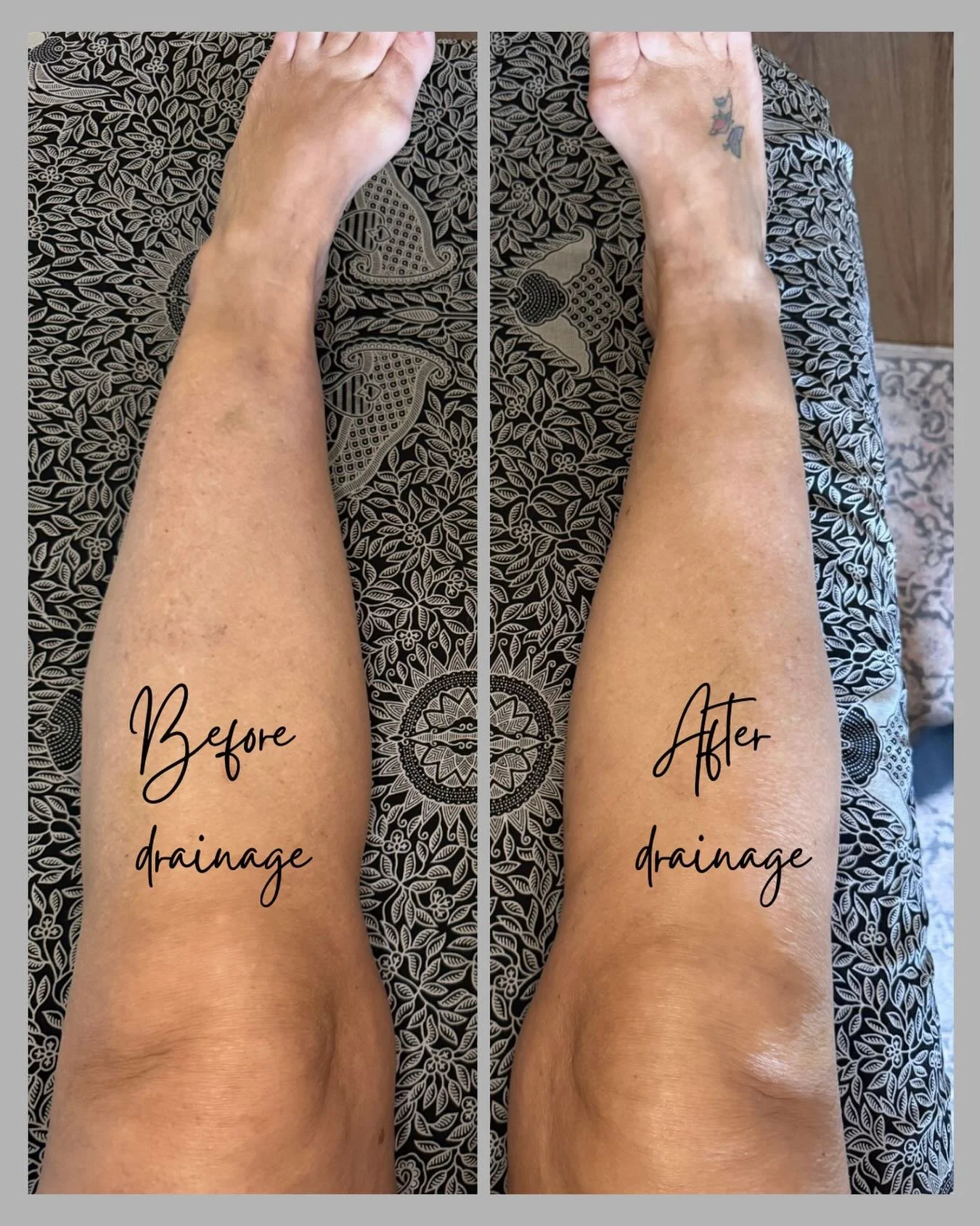 This client has mild oedema of the legs and just 10 minutes of MLD helped move the accumulated fluid and other byproducts back into circulation. 

Manual Lymphatic Drainage aims to support the body&rsquo;s natural ability to filter and remove waste, 